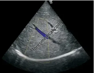 GE 3S-RS Cardiac Ultrasound Probe Scanner Head Crystal 