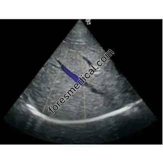 GE - GE 3S-RS Cardiac Ultrasound Probe Scanner Head Crystal 